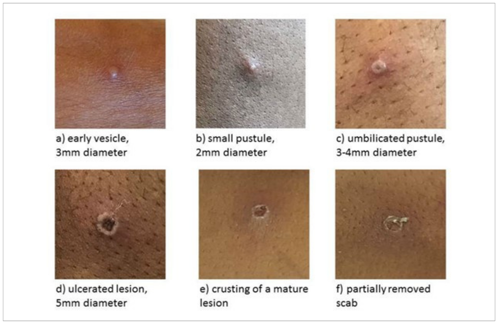 Images of monkeypox lesions