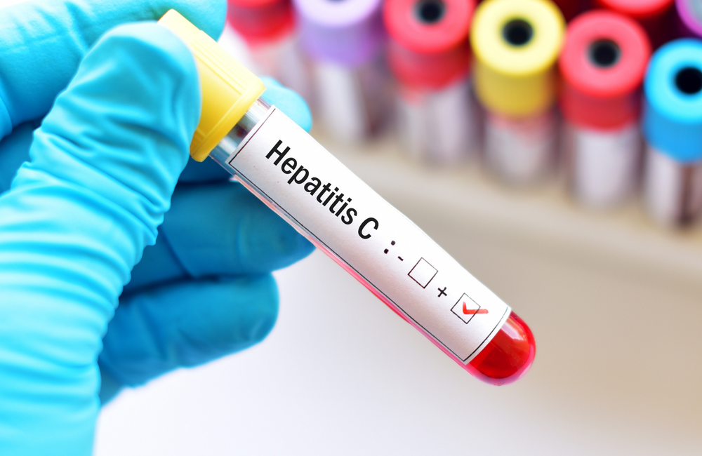 hepatitis c)
