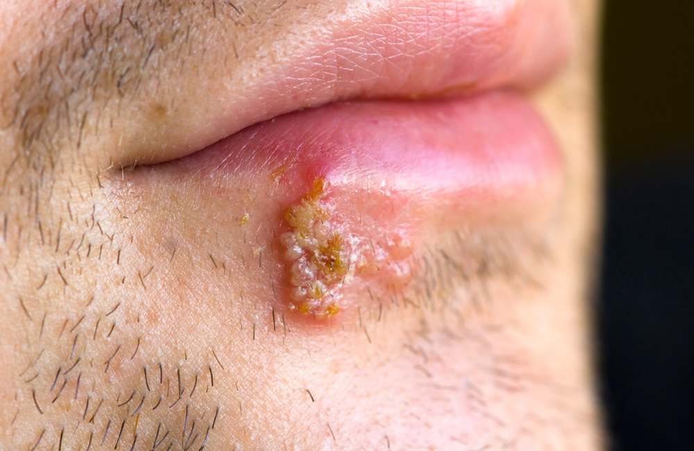 hiv symptoms on lips