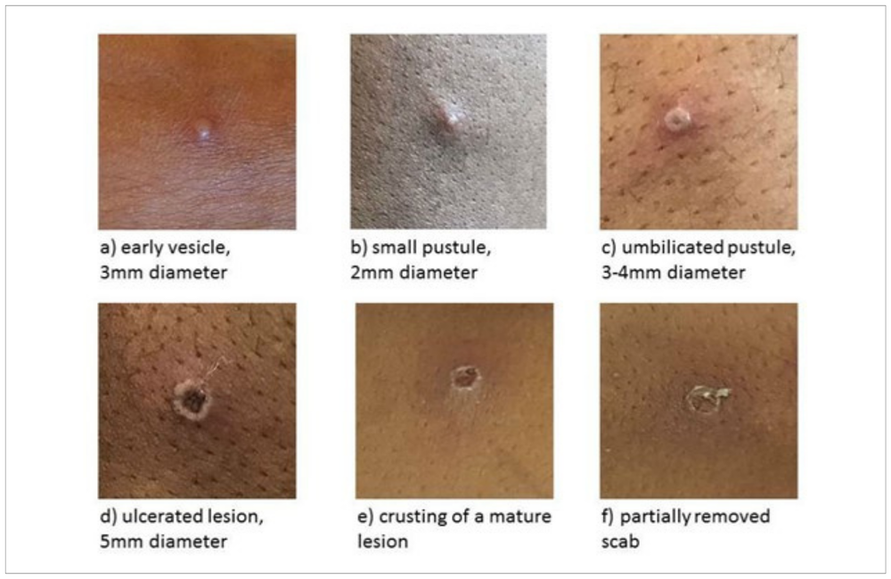 Study shows the spectrum of monkeypox symptoms | aidsmap