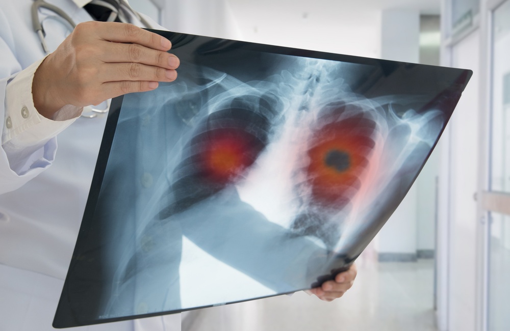 Hpv and lung cancer risk. Papillomas and lung cancer