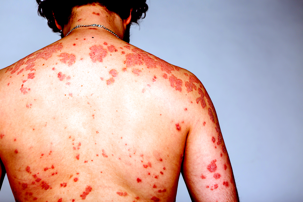 Acute HIV infection may present in many ways – sometimes as a serious  illness | aidsmap
