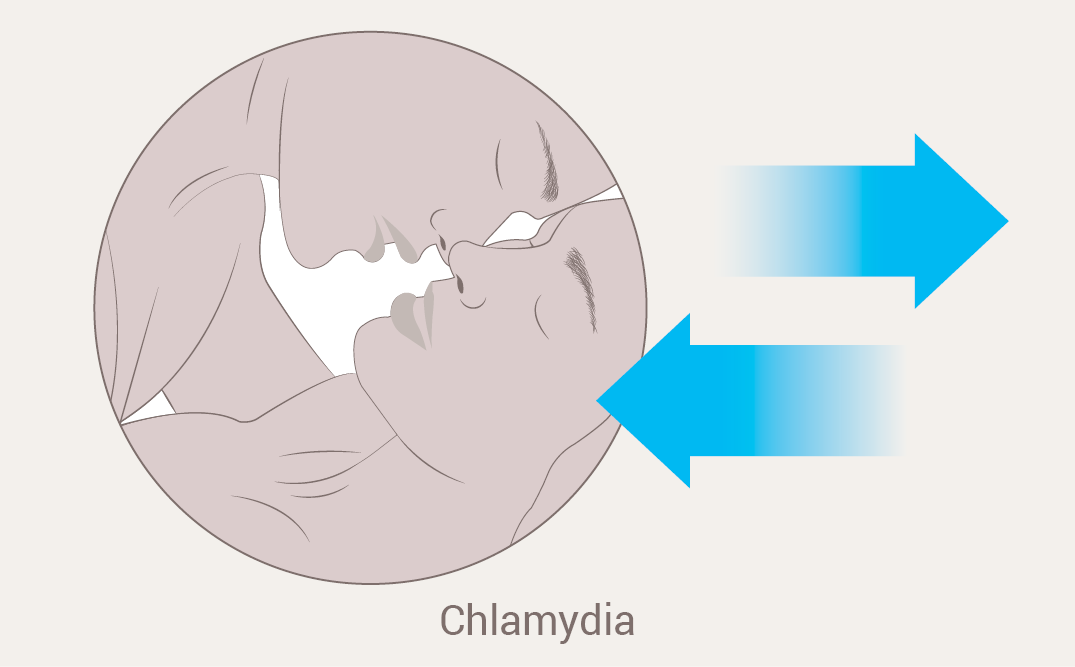 Chlamydia et le sexe anal